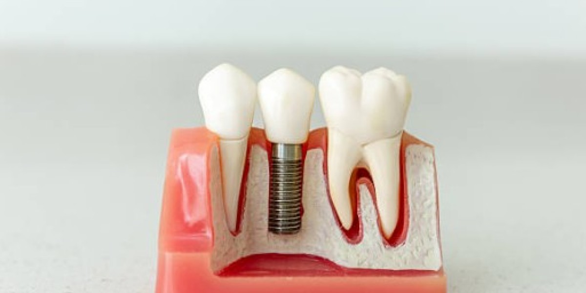 Why Manhattan Patients Choose Bone Grafts Before Dental Implant Surgery