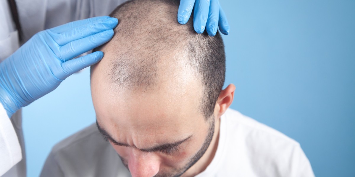 Does FUE Hair Transplant Affect Scalp Sensation?