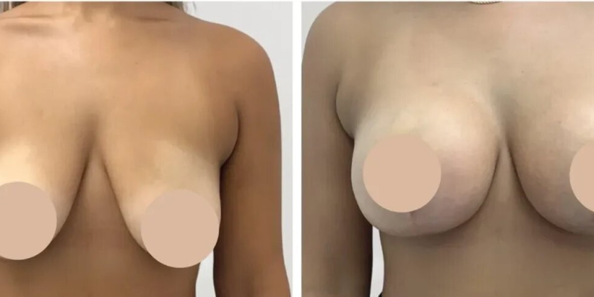 Best Breast Reduction Surgeons in Dubai for Comfortable Living and Confidence
