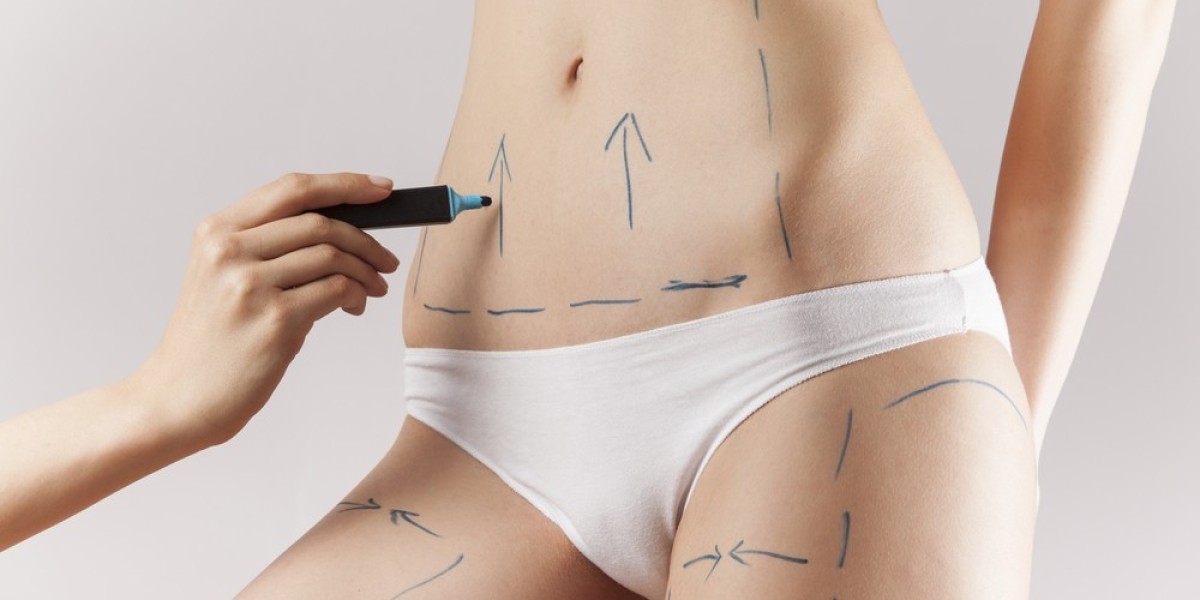 How Liposuction in Islamabad Supports Long-Term Body Maintenance