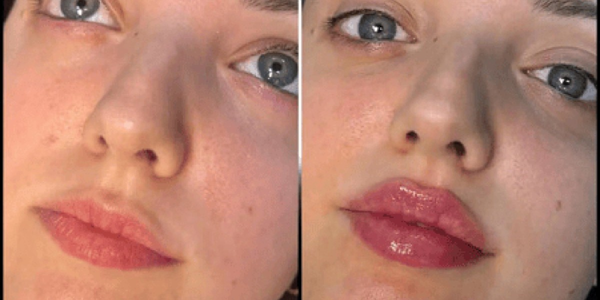 Best Aesthetic Clinics in dubai for Subtle Anti-Aging Fillers