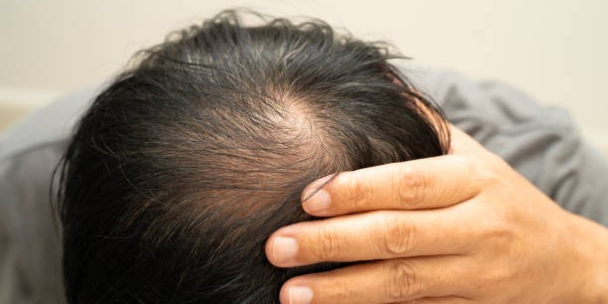 Exosomes Therapy for Hair Loss and Advanced Hair Rejuvenation