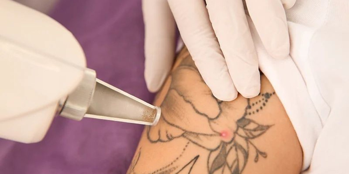 Tattoo removal in dubai: Targeted Ink Clearance