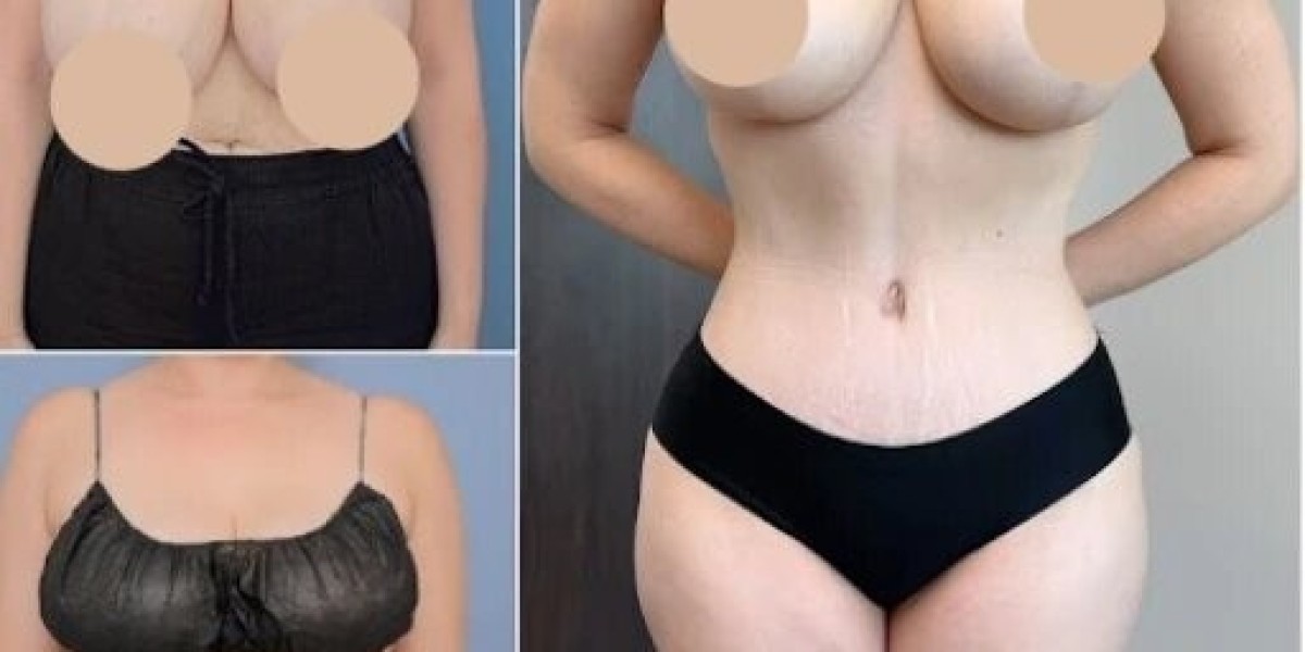 Best Tummy Tuck Surgeons in Dubai: Your Path to a Toned Abdomen