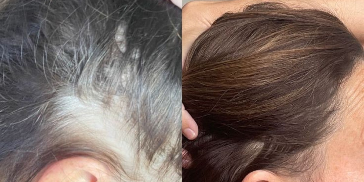 Hair Fillers in Dubai: Reversing Early Hair Loss