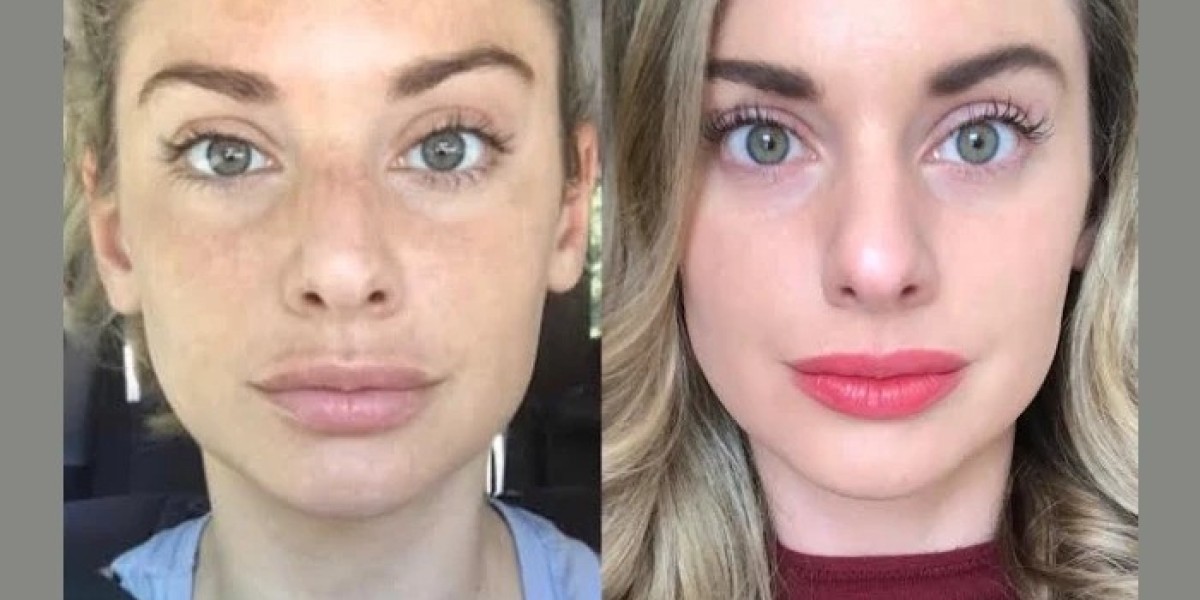 How the Best Plastic Surgeon in Dubai Uses RF Microneedling for Skin Renewal