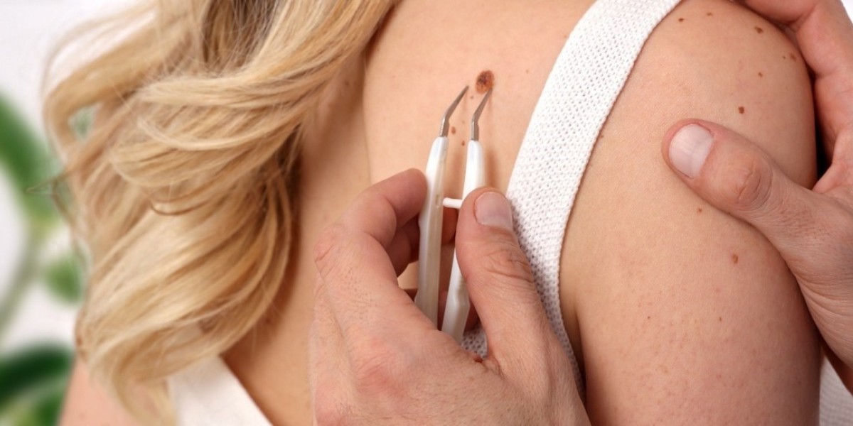The Psychological Impact of Mole Removal in Islamabad