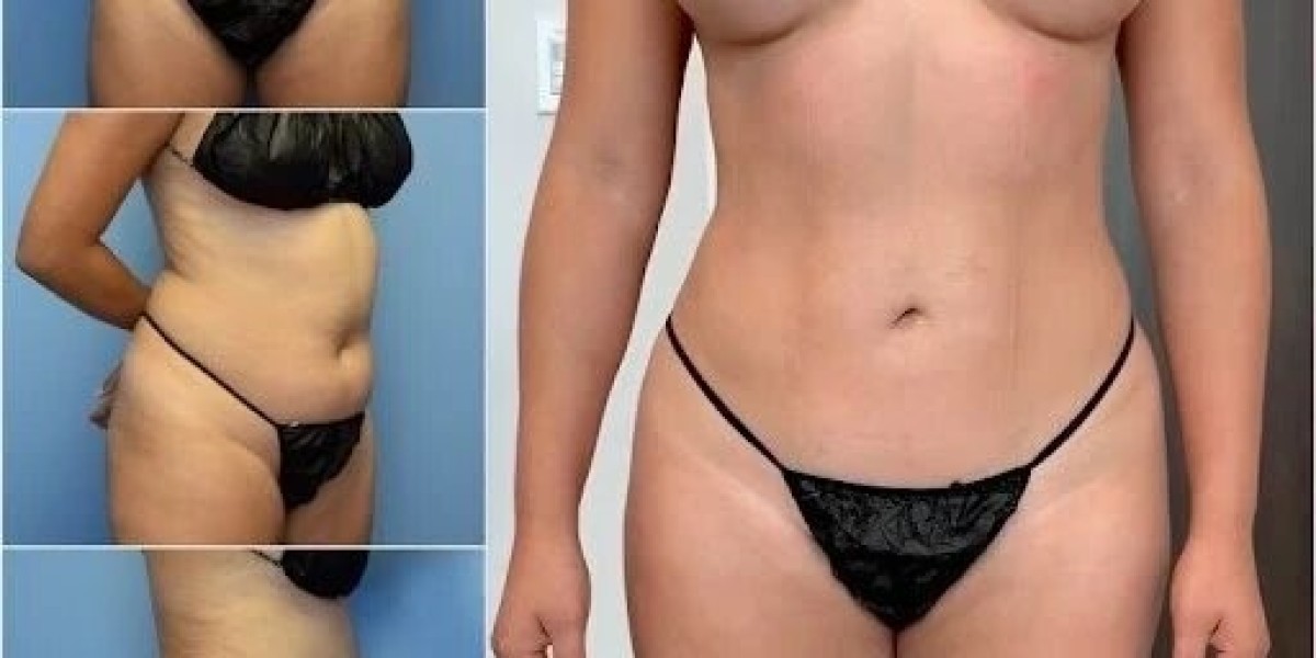 Best Body Contouring Surgeons in dubai for Men and Women