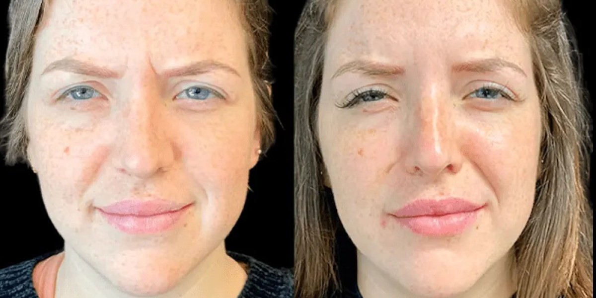 Best Aesthetic Clinics in Dubai for Anti-Aging Botox Procedures