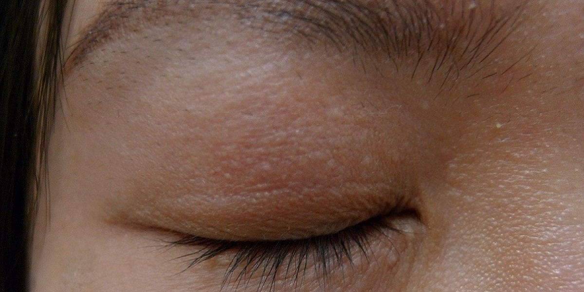Top 5 Clinics for Syringoma Removal Treatment in Dubai