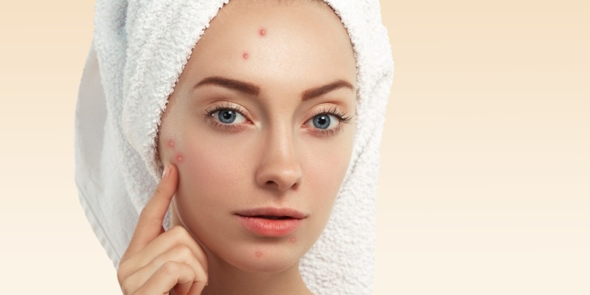 Acne Treatment In Manchester – Clear Skin, Renewed Confidence