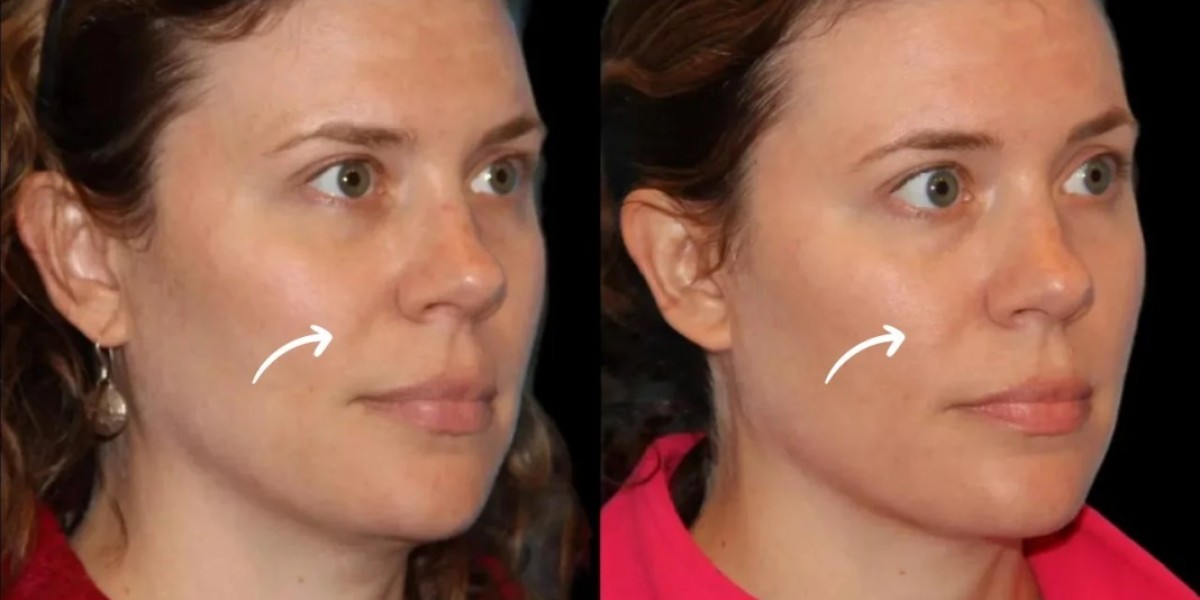 Best Doctors in Dubai Discuss Sculptra and Sun Exposure Care