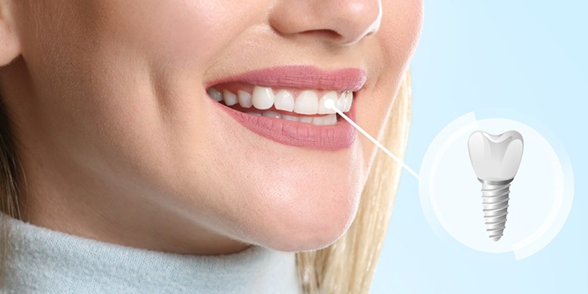 Dental implants in Dubai unlock a radiant confident smile journey