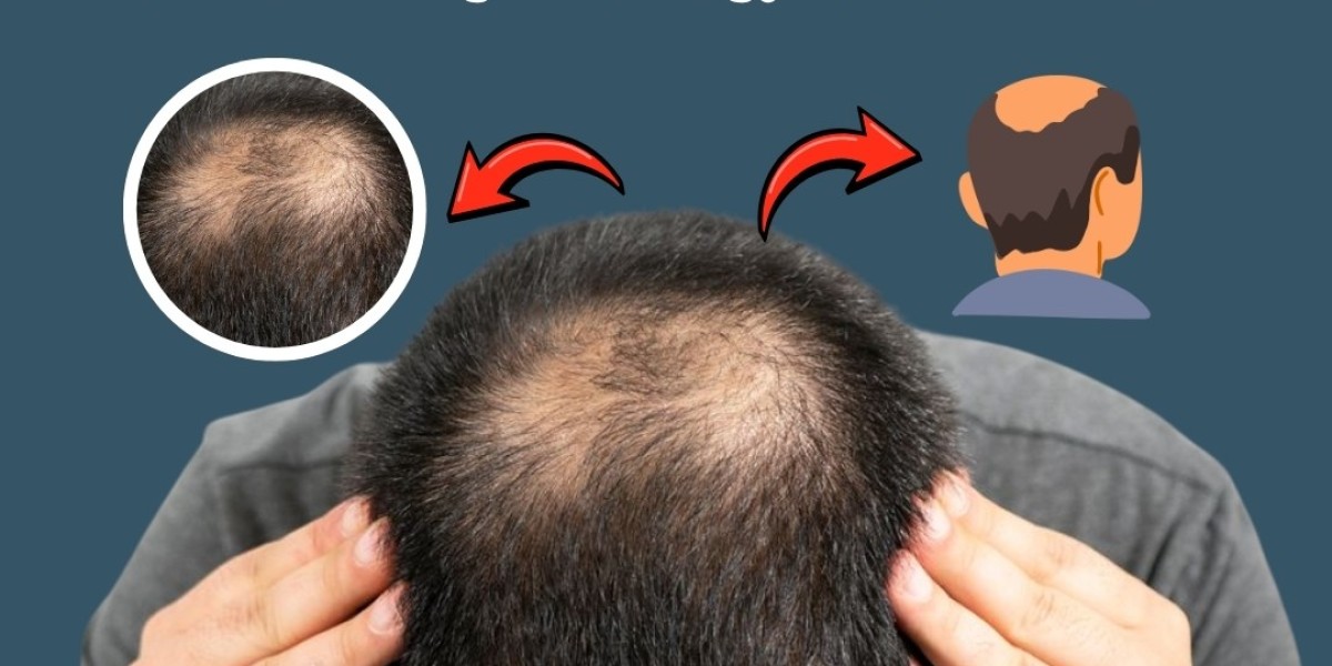 From Hair Loss to Hair Science: Understanding the Biology Behind Baldness