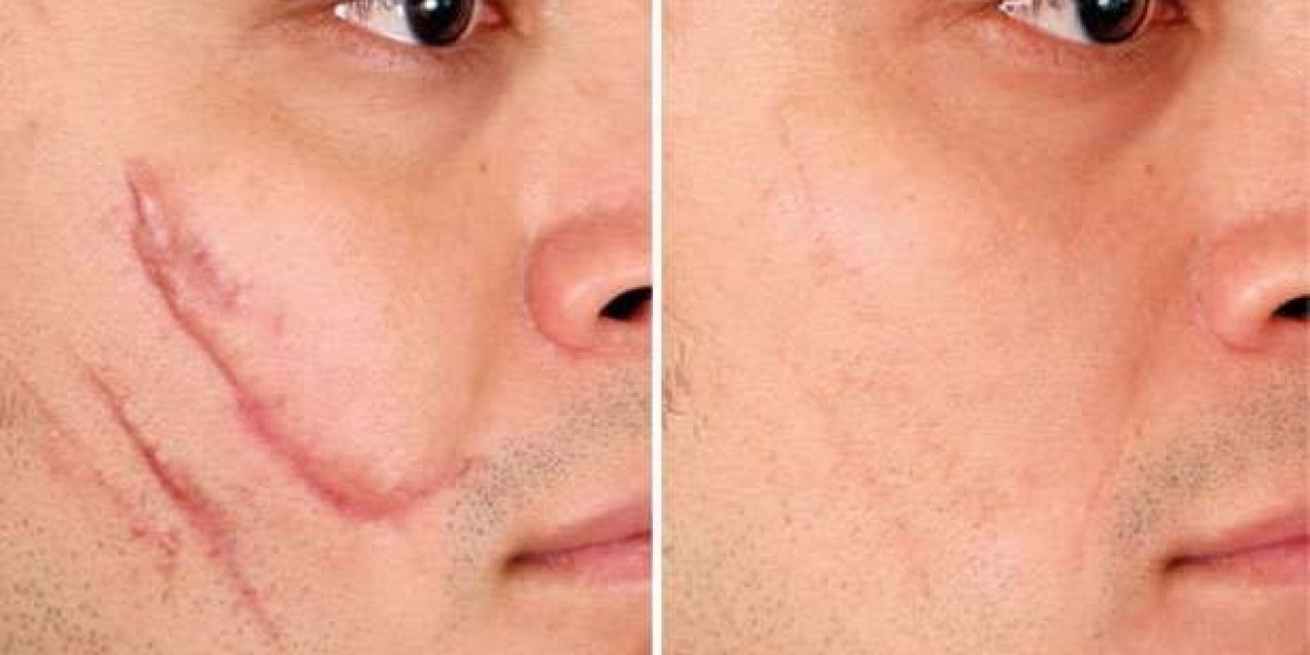 Scar Removal in Dubai: Tailored Plans for Clearer Skin