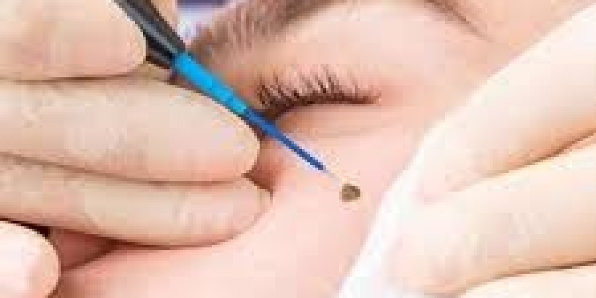 Laser Wart Removal in Dubai for Hands, Feet, and Face | Safe & Effective Treatment