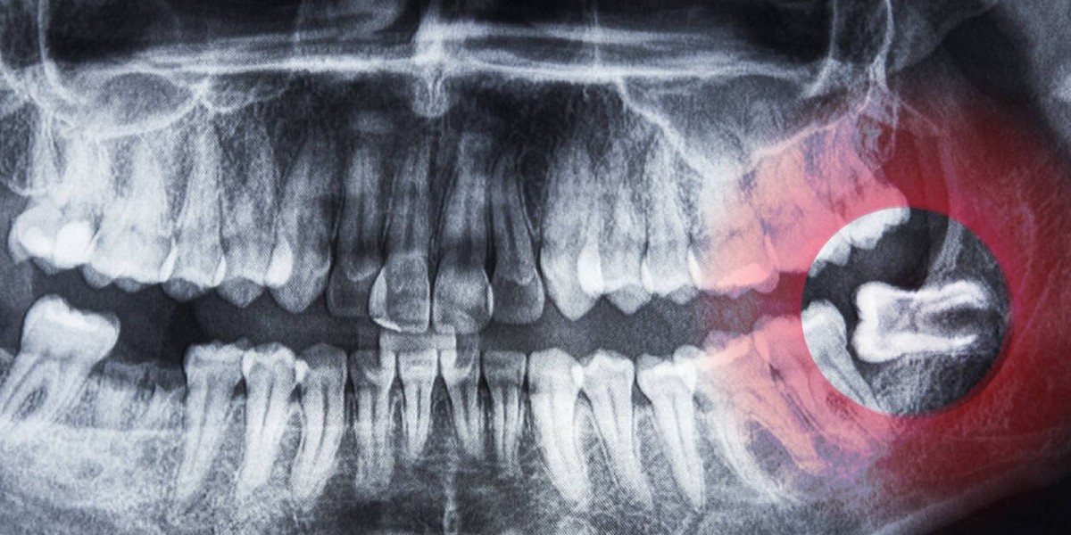 Professional Teeth Whitening in Dubai Explained