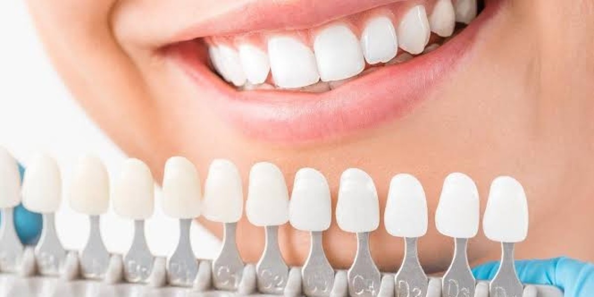 Dental Veneers Explained: Are They Worth the Cost?