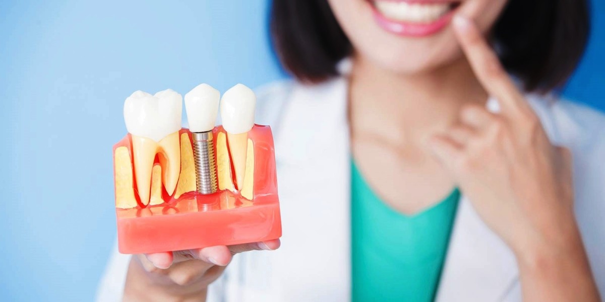 Dental Implants in Dubai vs Dental Bridges