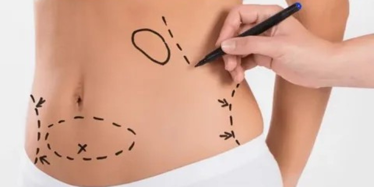 Tummy Tuck in Dubai: Reclaim Your Pre-Weight Loss Shape