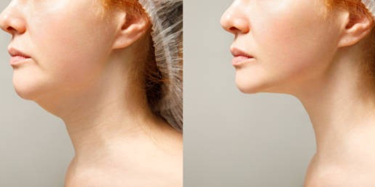 How Jawline Surgery in Dubai Refines Your Appearance