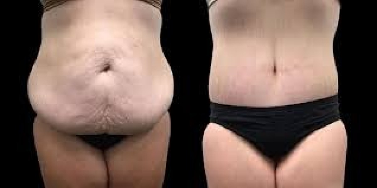 Is Post-Weight Loss Surgery in Dubai Right for You? Complete Guide to Body Contouring