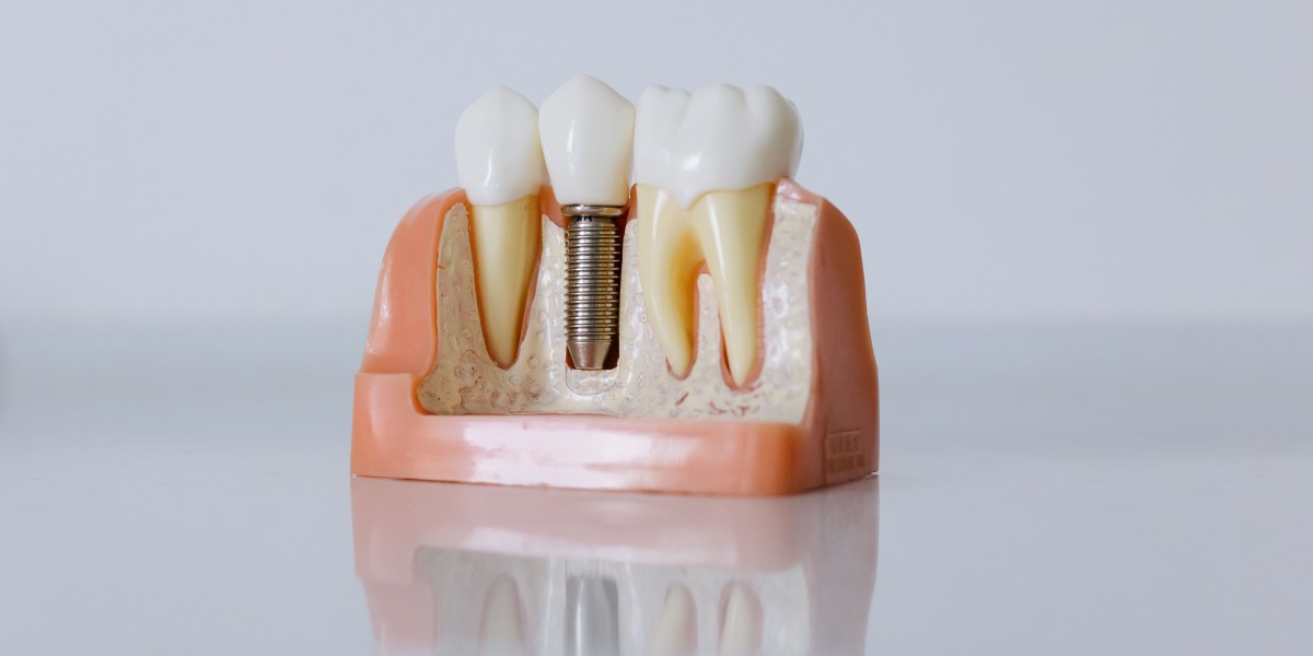 Dental Implants Oxnard Explained: Procedure, Recovery & Benefits