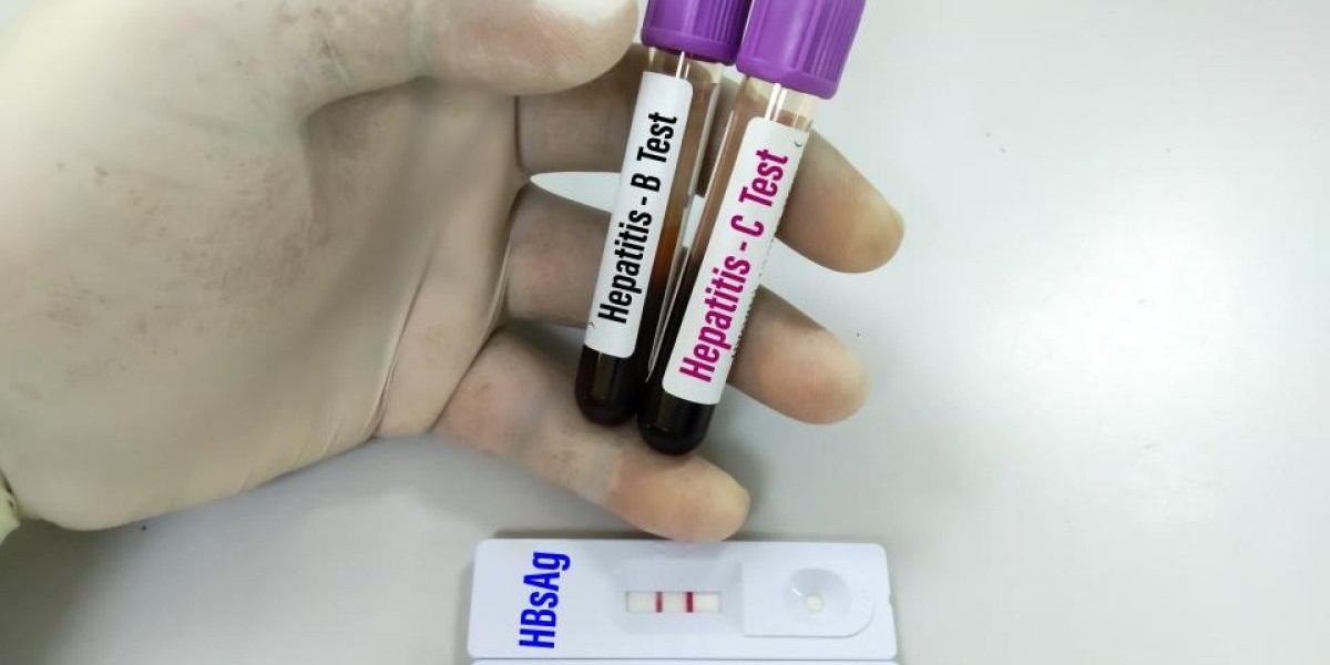 Hepatitis B Test in Dubai Before Medical Procedures