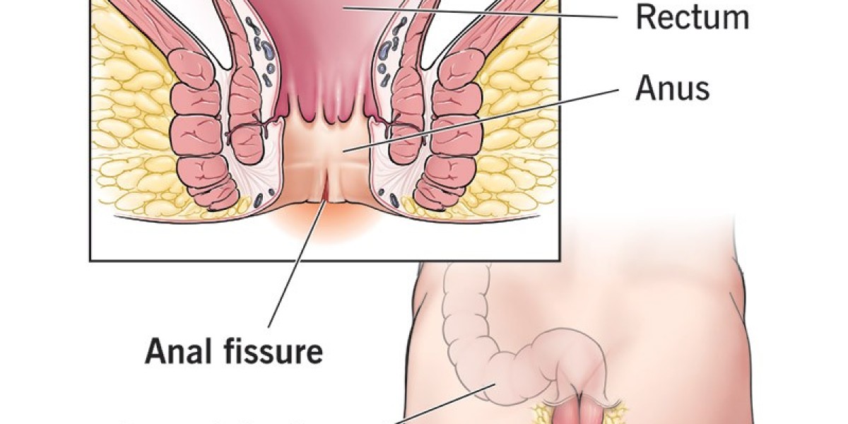 Fissure Treatment in Thrissur