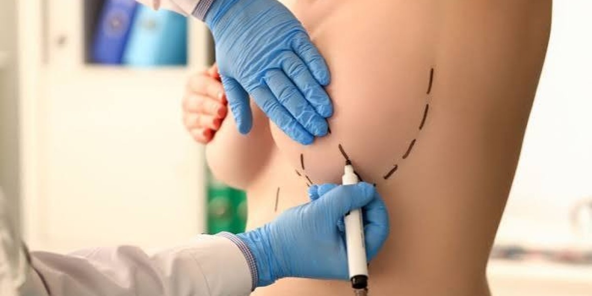 Thinking About Breast Reduction Surgery? Here's What You Should Know First
