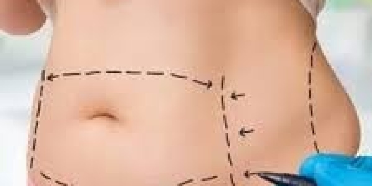Liposuction Surgery in Dubai | Benefits, Procedure & Recovery Guide