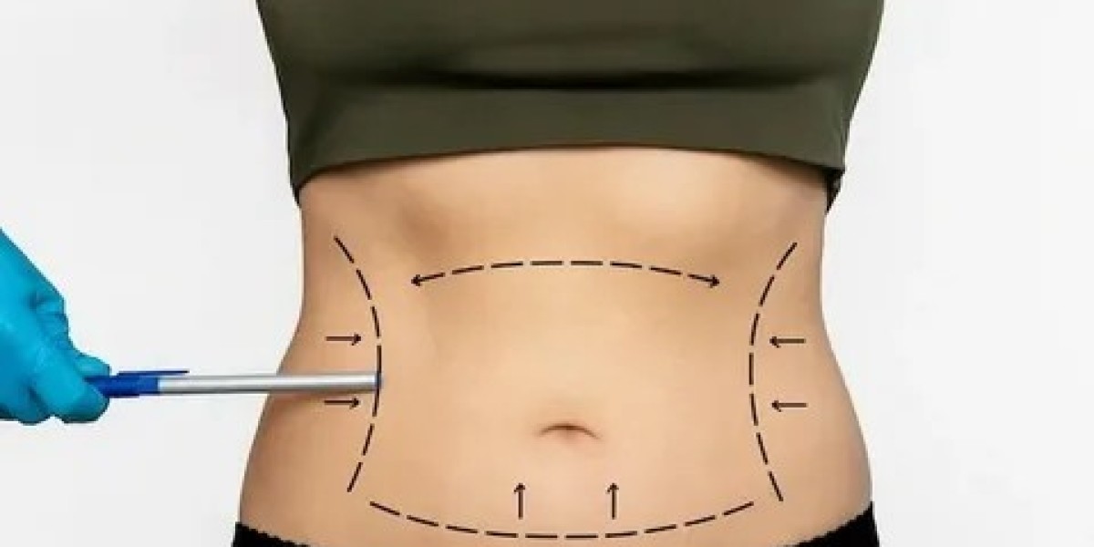 Liposuction Surgery in Dubai: Reshaping Your Future Today