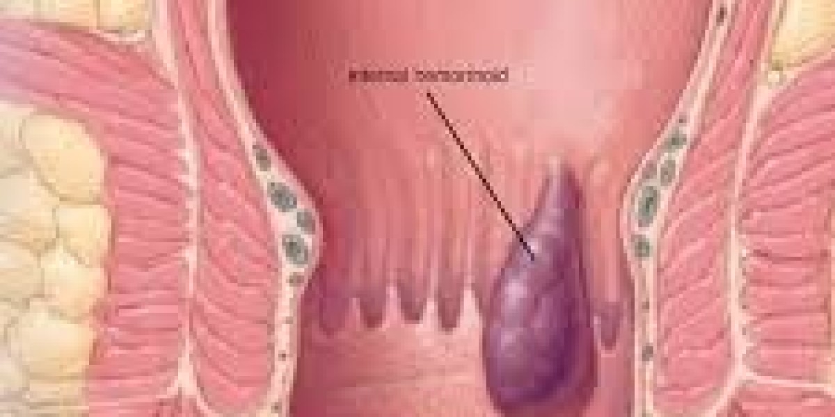 Haemorrhoids Treatment in Dubai | Restore Comfort and Relief